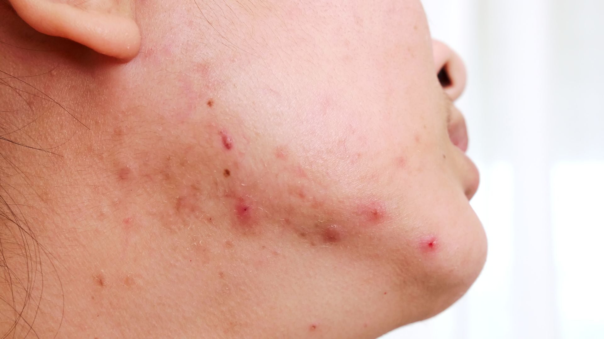 Does menopause cause a ‘collagen cliff’? What you need to know - The Conversation